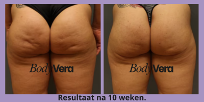 files/before_and_after_2_bodyvera_new_paars.png