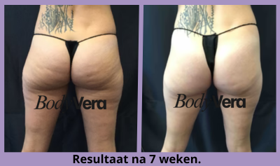 files/before_and_after_4_bodyvera_new_paars.png